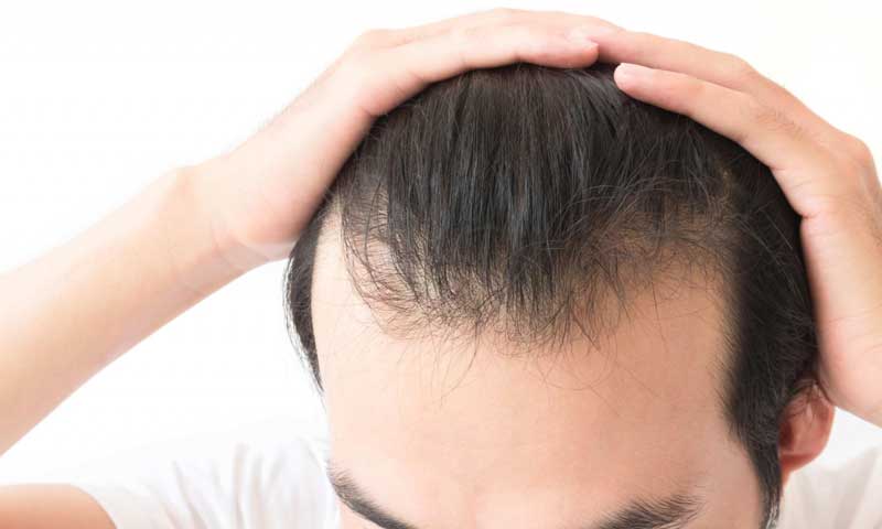 Rụng tóc ở xoáy đầu  liệu có khó chữa  Cấy Tóc Quốc Tế